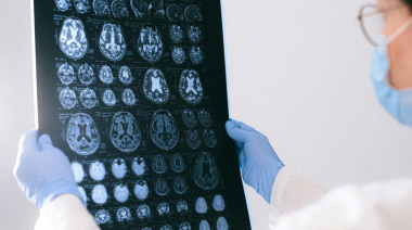 Identifican en sangre biomarcadores prometedores para el diagnóstico y monitoreo de la epilepsia