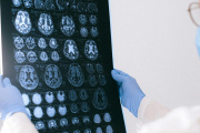 Identifican en sangre biomarcadores prometedores para el diagnóstico y monitoreo de la epilepsia