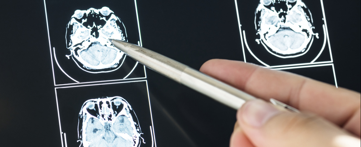 Meningitis: aumentan los casos y preocupa la caída en la vacunación adolescente