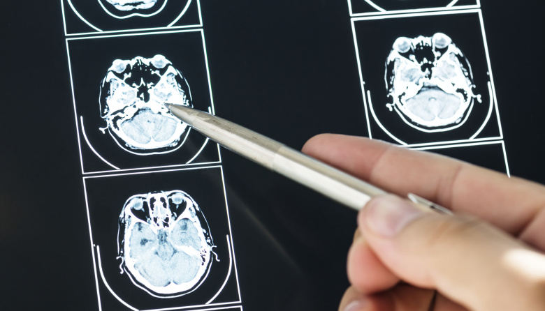 Meningitis: aumentan los casos y preocupa la caída en la vacunación adolescente