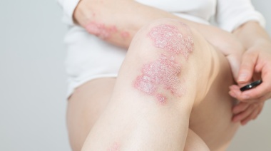 Mitos más comunes de la psoriasis: la importancia de desmitificar