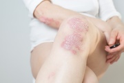 Mitos más comunes de la psoriasis: la importancia de desmitificar