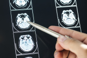 Meningitis: aumentan los casos y preocupa la caída en la vacunación adolescente